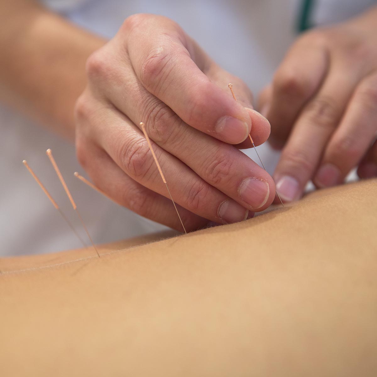 Acupuncture needles on back of a young woman